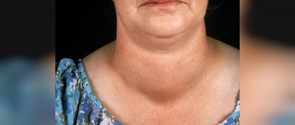 Лишний Вес Из-За Щитовидной Железы