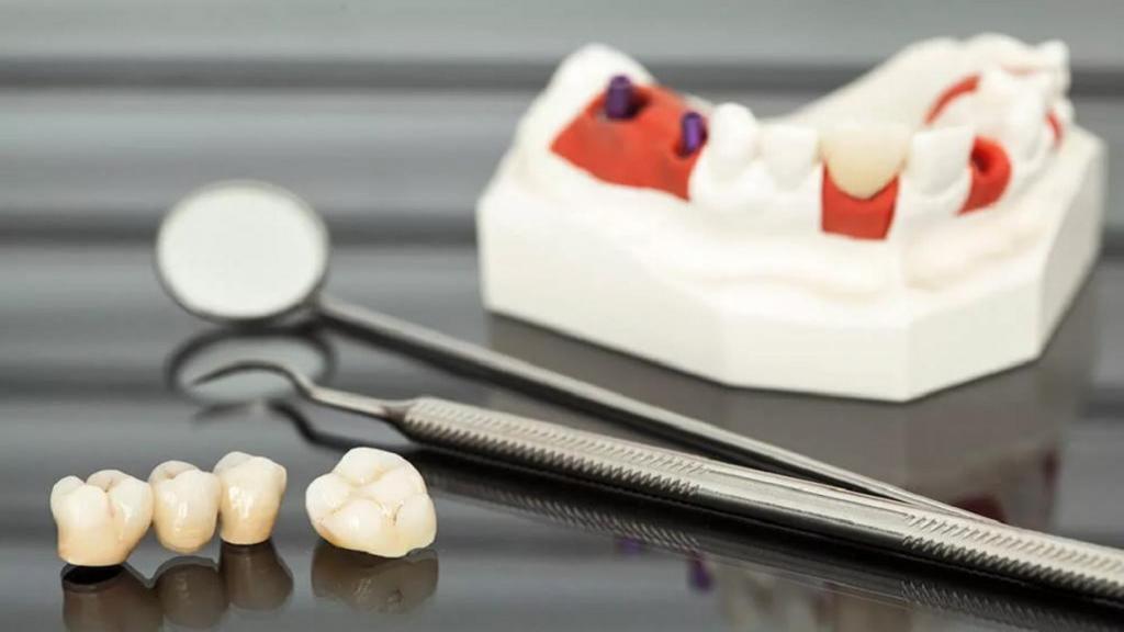 علت عفونت دندان روکش شده چیست و چگونه درمان میشود + انواع روکش