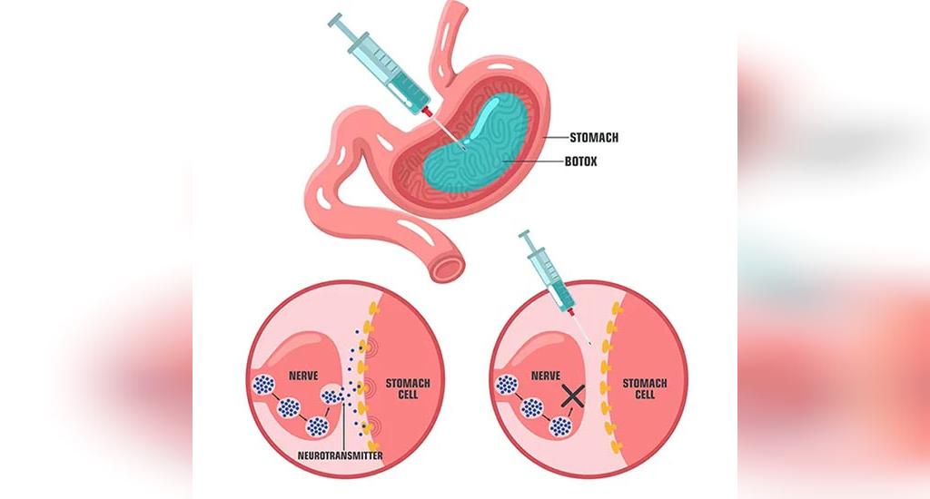 تحول در کاهش وزن 2025