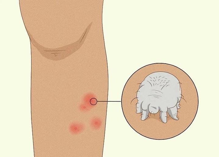 علت شایع خارش پاها  9