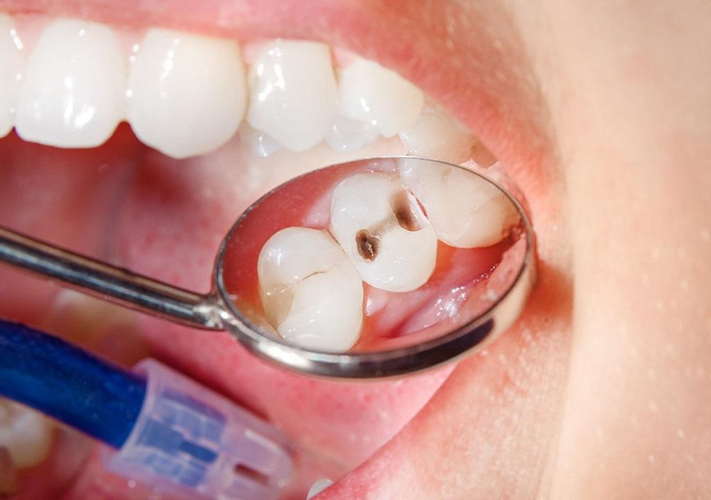 پیشگیری از پوسیدگی دندان 