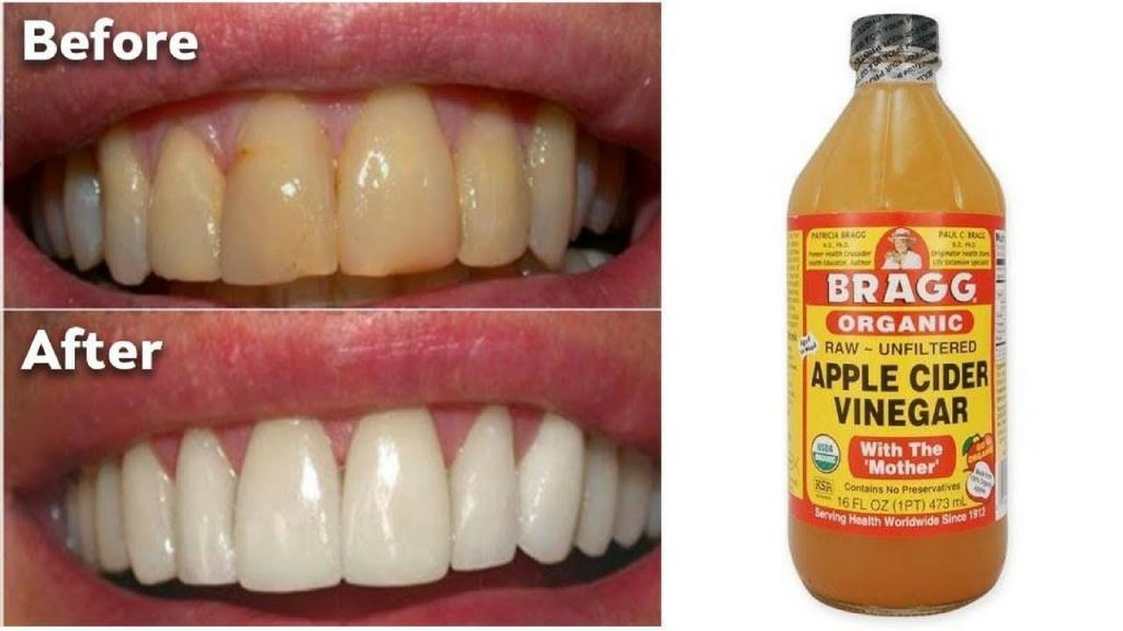 سفید کردن دندان با سرکه سیب