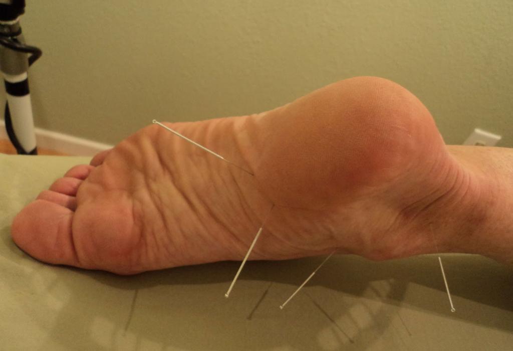 گزینه های درمانی برای سوزش پا