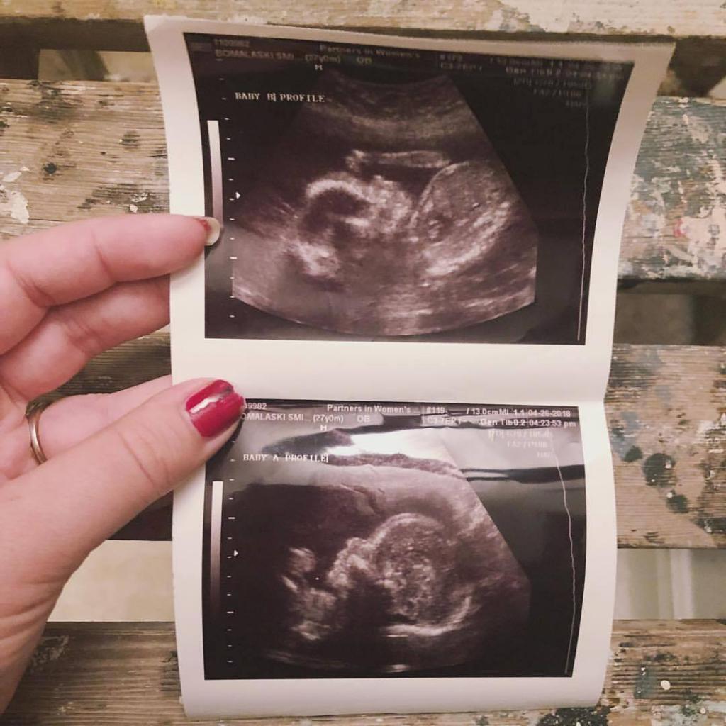 سونوگرافی هفته بیست و یکم بارداری