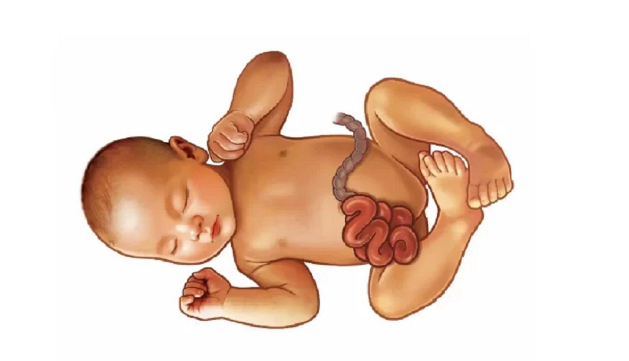 علائم اکستروفی مثانه