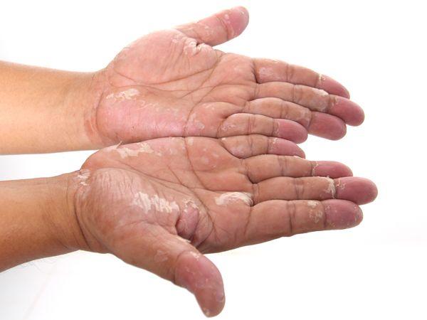 چگونه از پوسته پوسته شدن نوک انگشتان جلوگیری کنیم؟