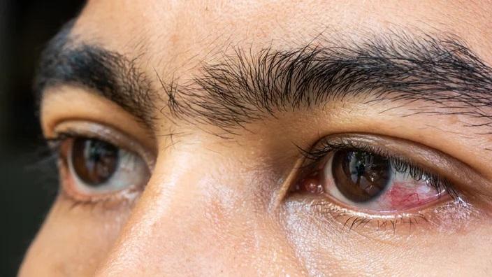 تعبیر خواب بیماری چشم 2