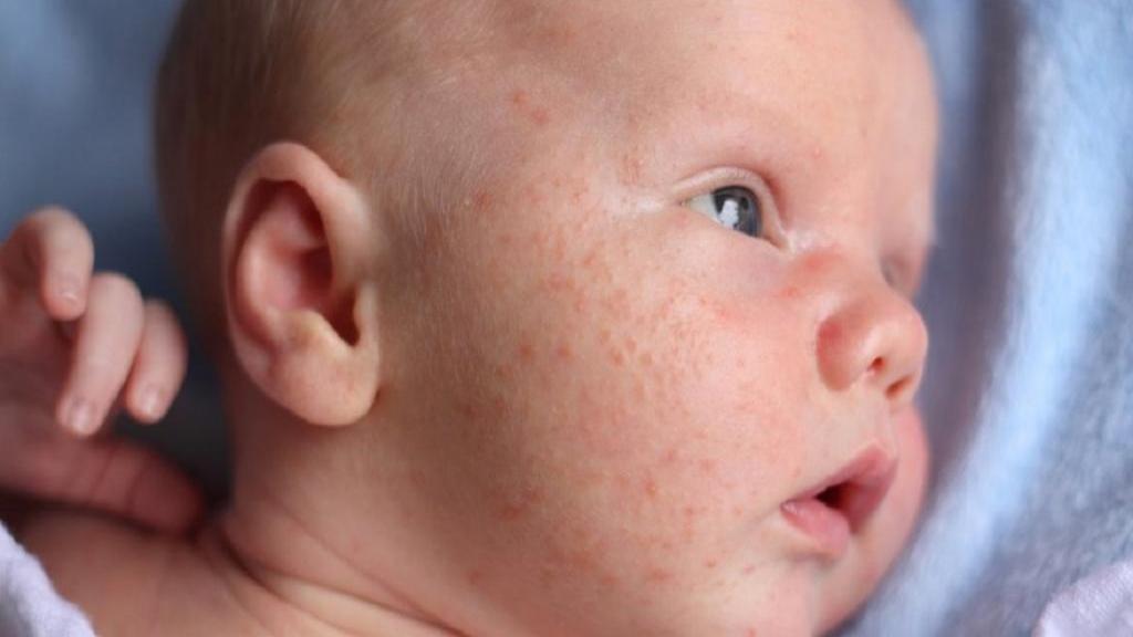 آلرژی های (حساسیت) پوستی در نوزادان: تصاویر، علل، علائم و درمان