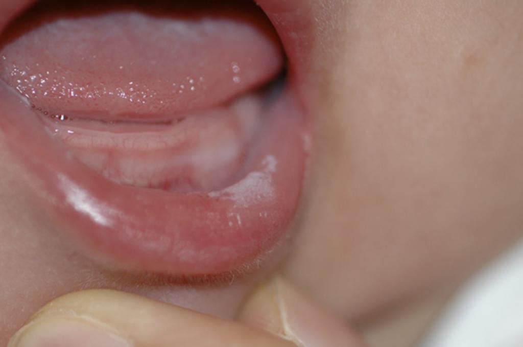 آفت دهان برای نوزادان