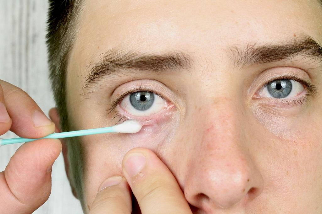 درمان عفونت چشم با طب سنتی