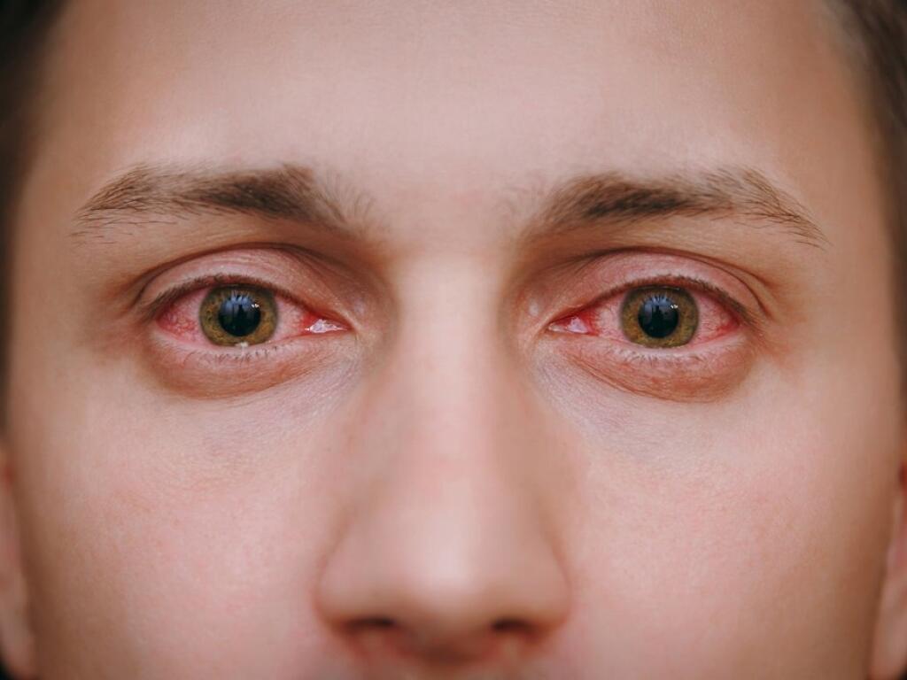 درمان نزله چشم
