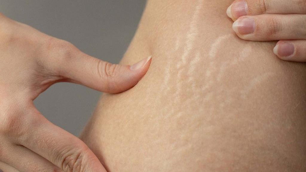 درمان ترک های پوستی ناشی از چاقی، بارداری با لیزر، کرم و روغن