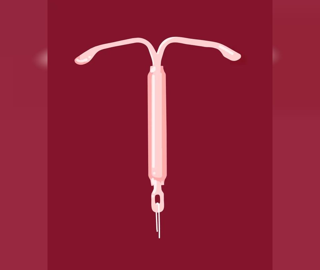  میرنا (IUD) دستگاه داخل رحمی 