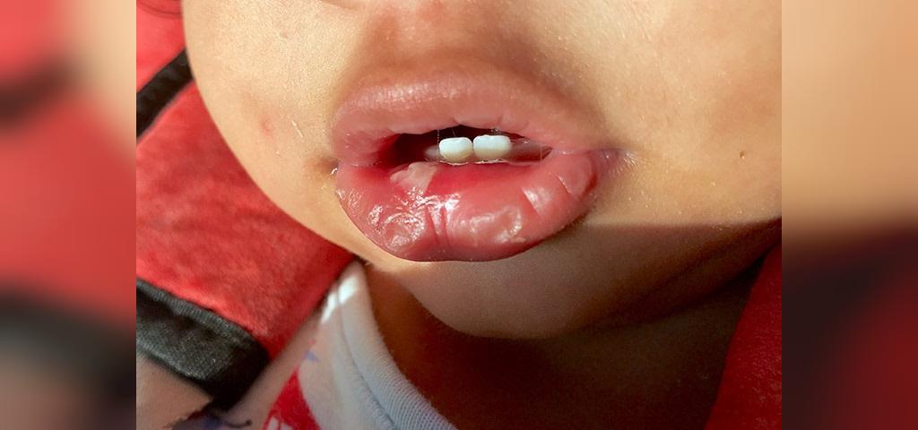 چطور می توان زخم های دهان نوزاد را تشخیص داد؟