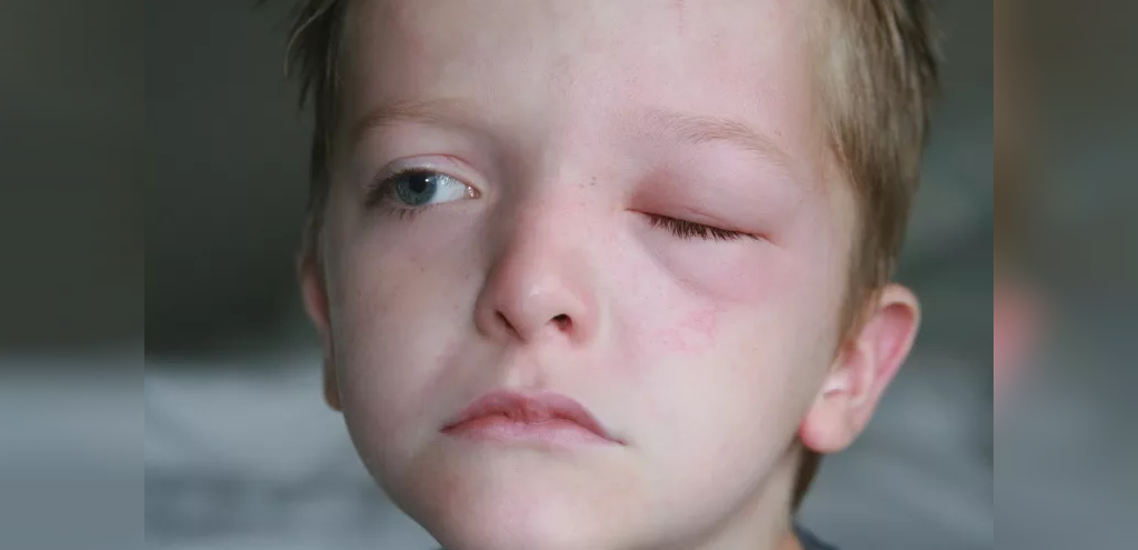  عفونت چشم در کودکان زیر یکسال