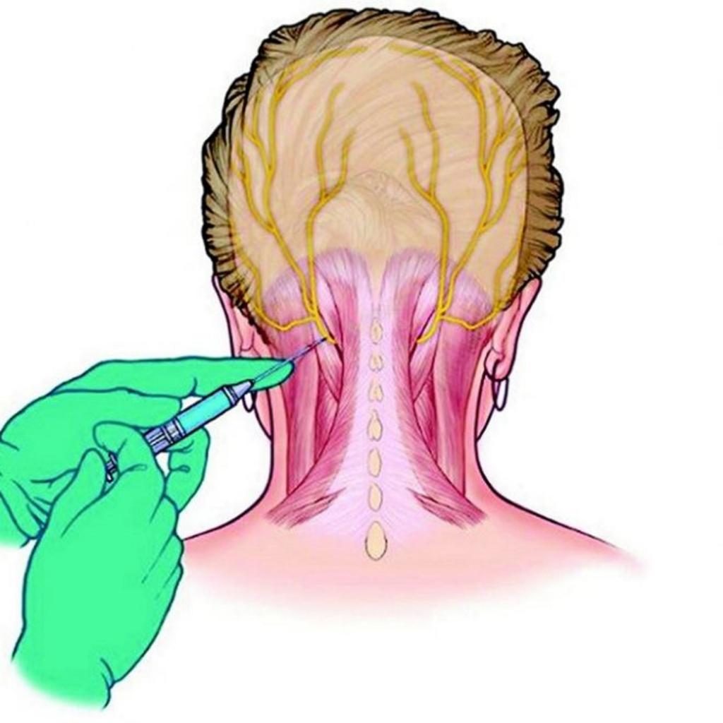 روش های درمانی درد مزمن:بلوک عصبی