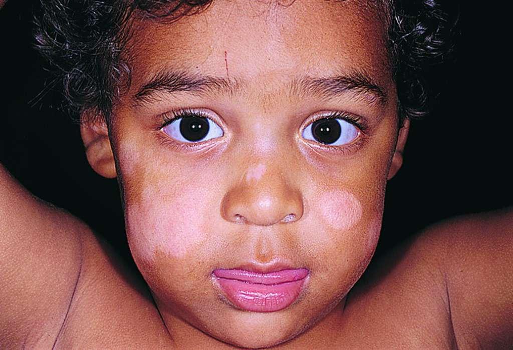 پیتریازیس‌ آلبا از علت های ایجاد لک های سفید روی پوست