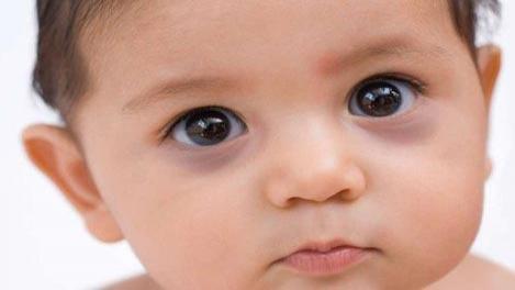 تیرگی دور چشم نوزادان چیست؟ (علل و راه های درمان آن)