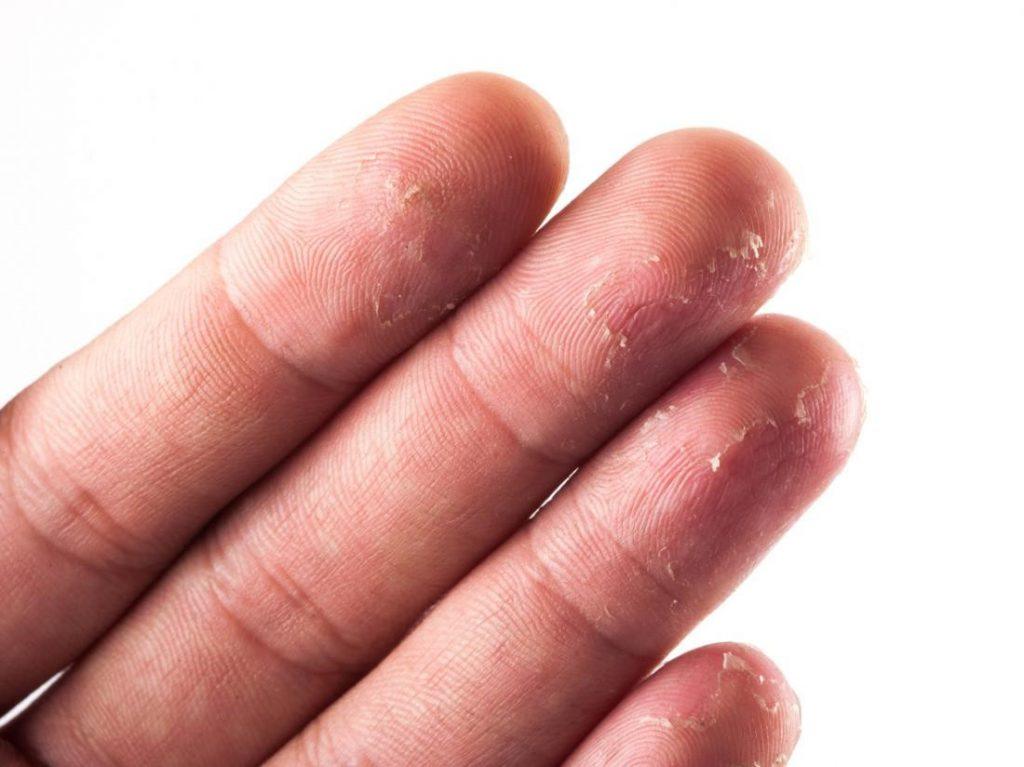 چه چیزی باعث پوسته پوسته شدن نوک انگشتان می شود؟