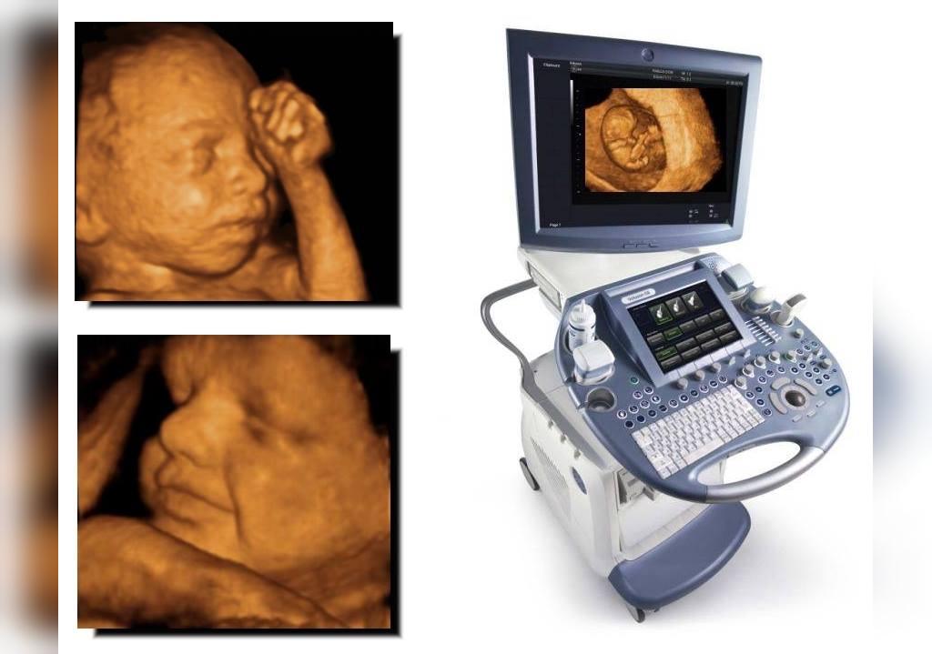  سونوگرافی آنومالی یا سونوگرافی میانه بارداری
