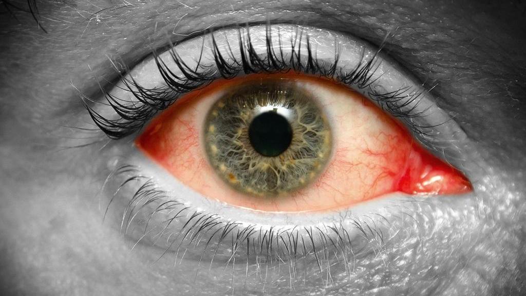 علت و درمان عفونت چشم با داروی گیاهی، خانگی، پماد و طب سنتی