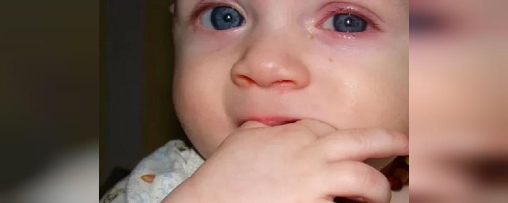 علائم عفونت چشم نوزادان 