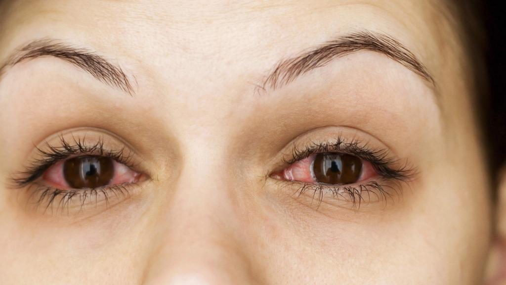 علت سنگین شدن پلک چشم و درمان آن