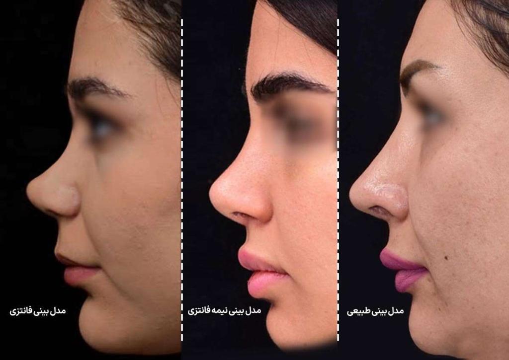 انواع فرم‌های بینی