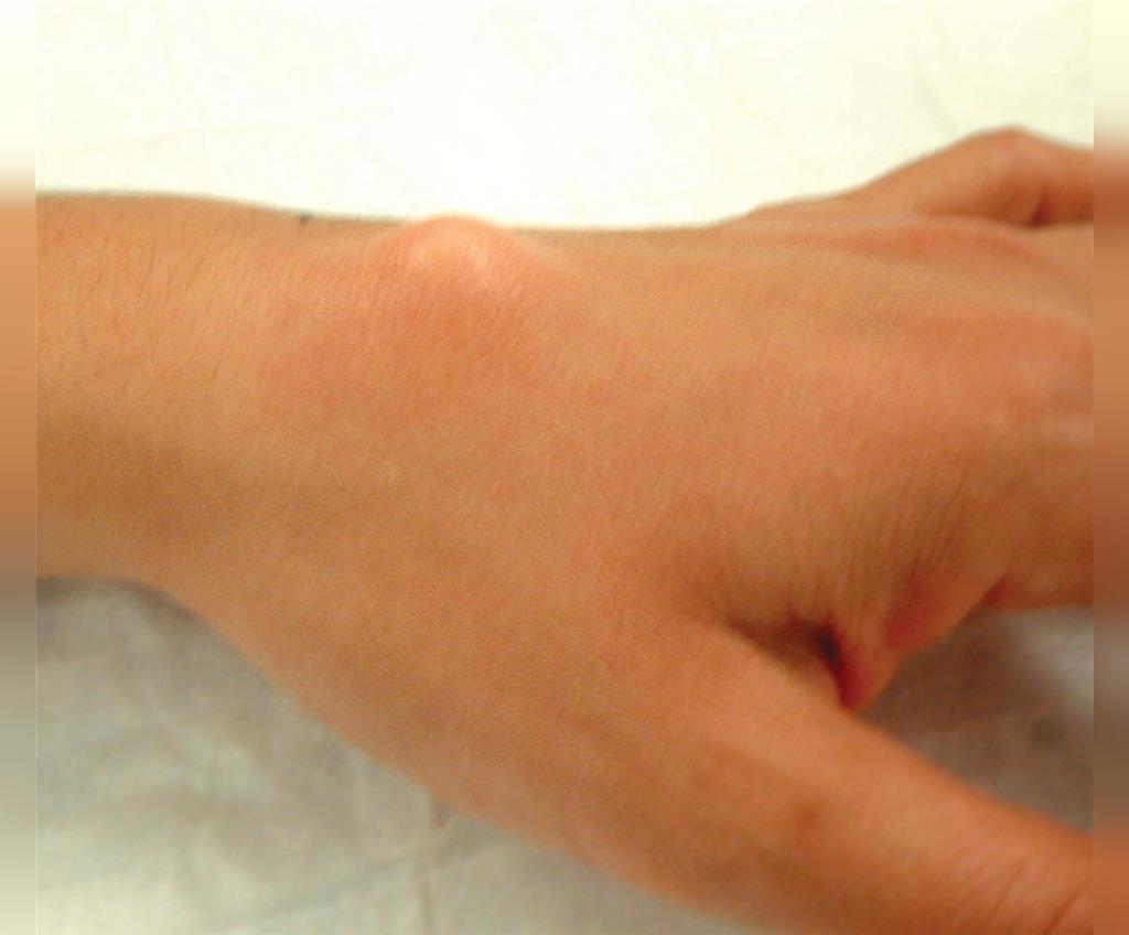 درمان کیست گانگلیون مچ دست