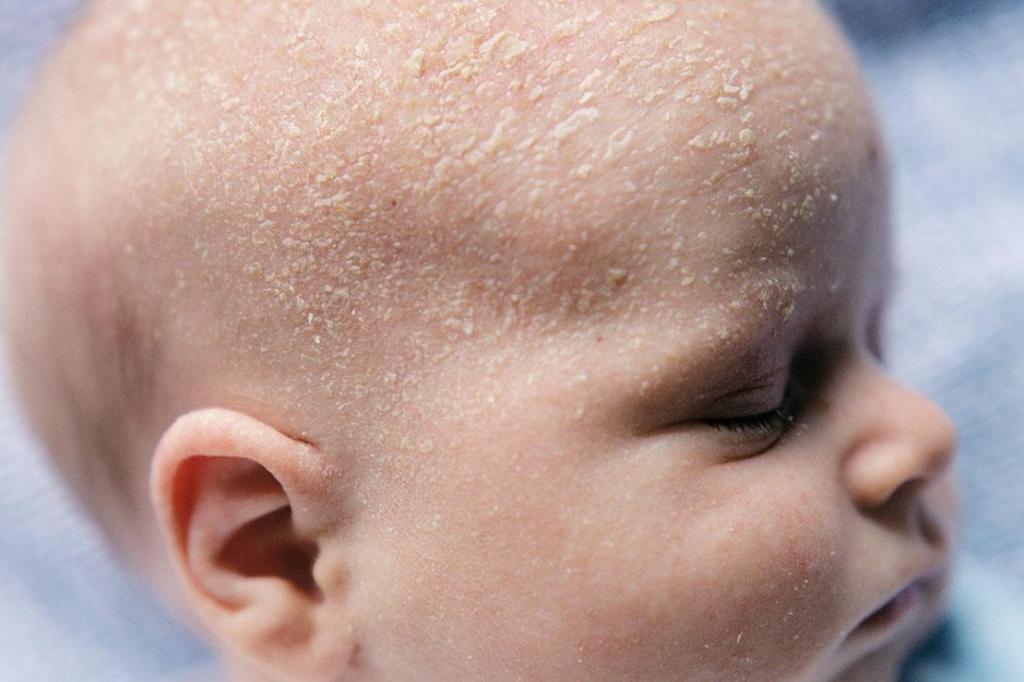 دونه های سفید روی پوست نوزادان