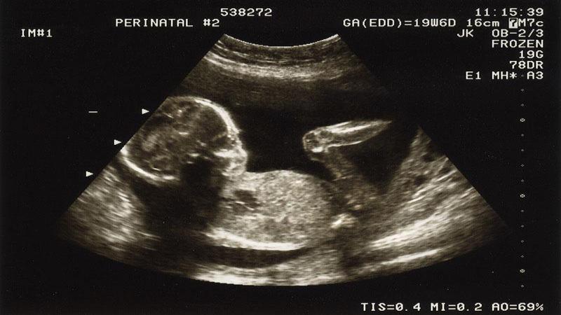 سونوگرافی آنومالی در هفته 20 بارداری؛ دلایل ضرورت انجام سنوگرافی آنومالی و اطلاعاتی که باید دانست