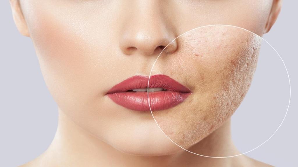 درمان خانگی پوست پرتقالی و بستن منافذ باز پوست با ماسک و داروهای گیاهی