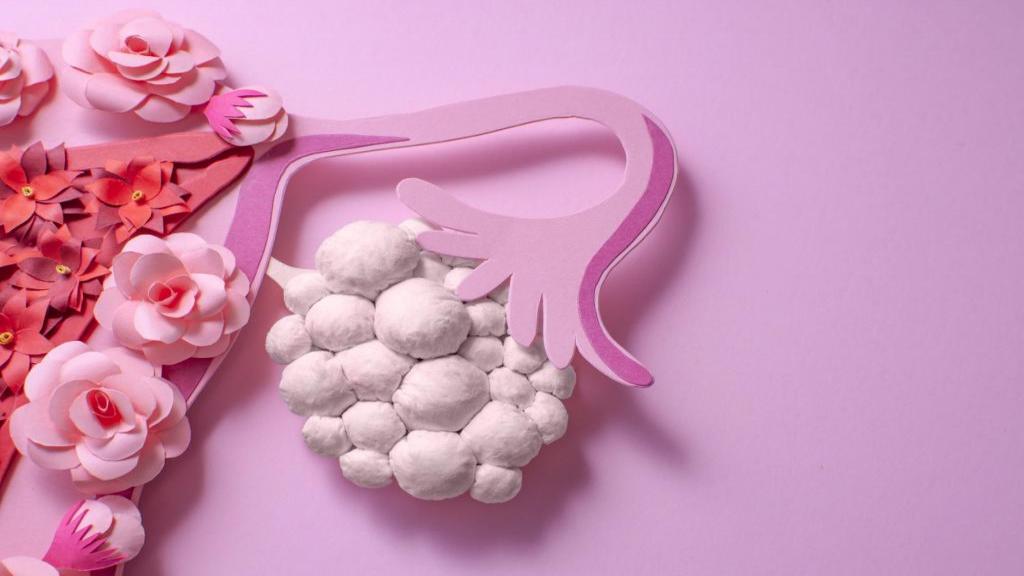 تنبلی تخمدان (سندروم تخمدان پلی کیستیک) چیست و درمان آن