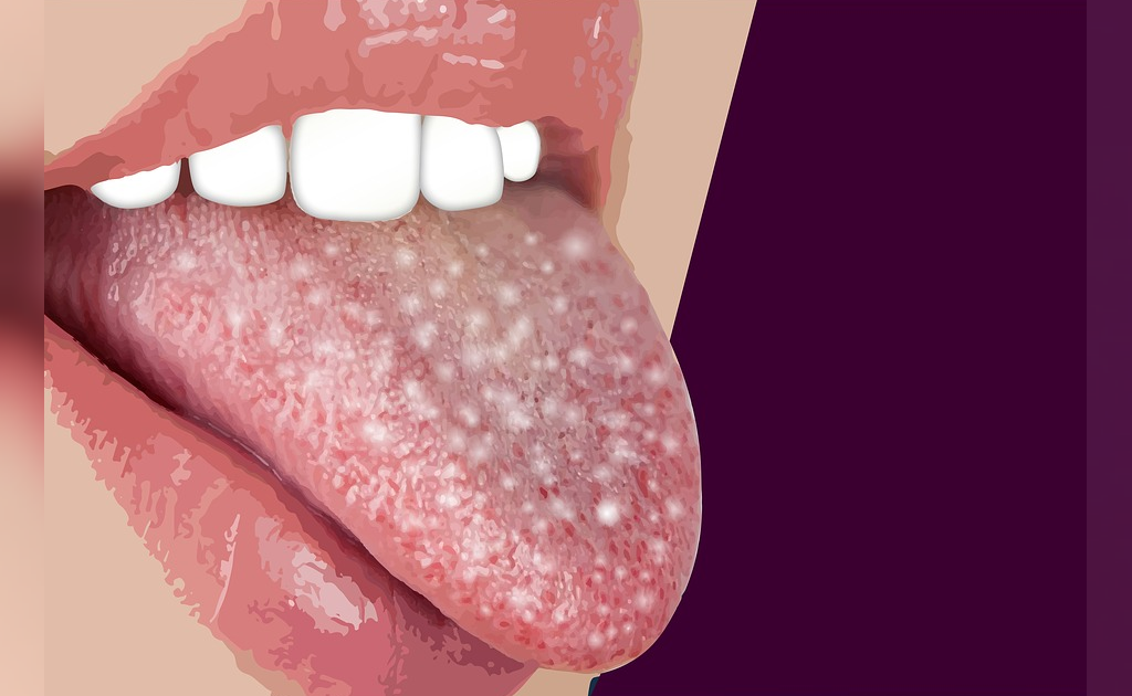 علت به وجود آمدن عفونت های دهانی