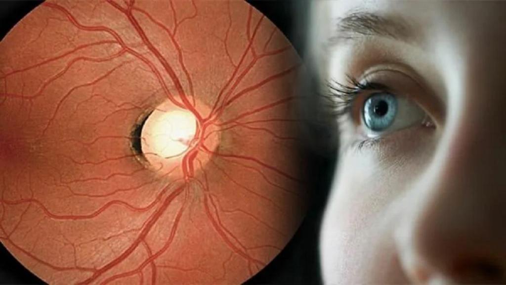 دژنراسیون ماکولای خشک یا تباهی لکه زرد چشم چیست + درمان آن