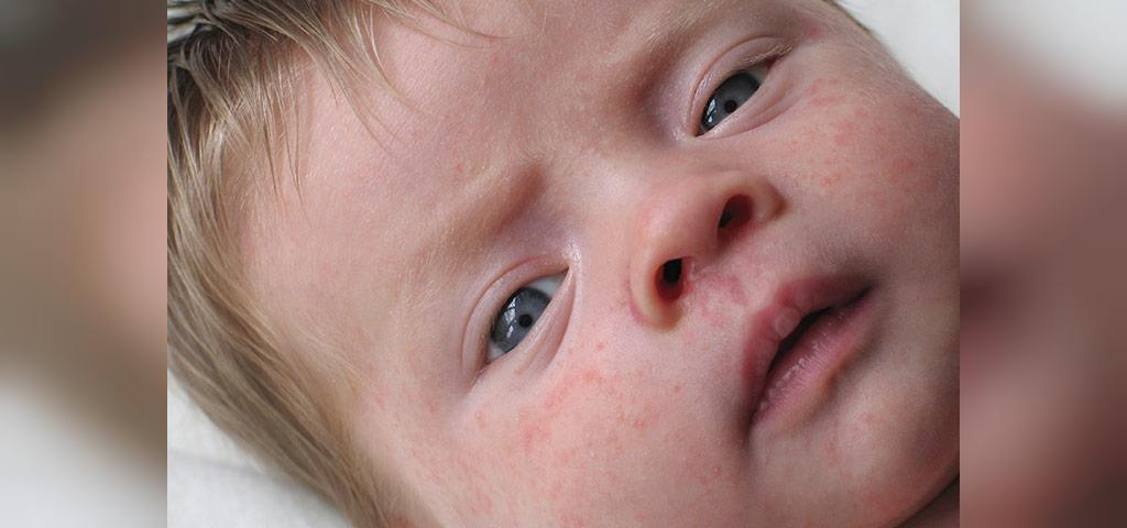 انواع متداول حساسیت پوستی که در نوزادان دیده می شود