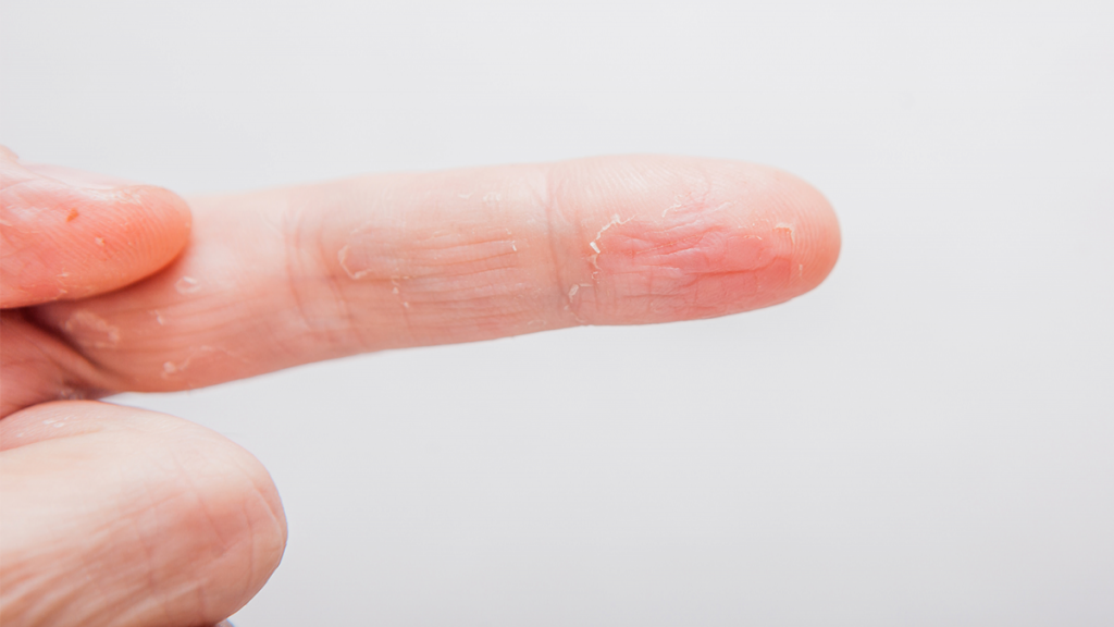 علت پوسته پوسته شدن نوک انگشتان چیست؛ درمان خانگی آن در طب سنتی