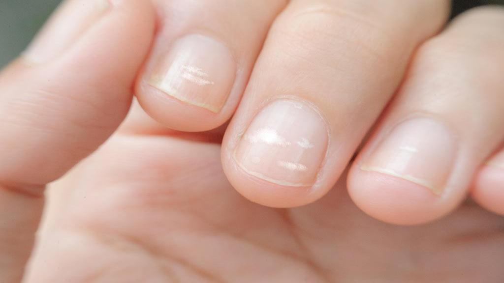لکه های سفید بر روی ناخن (لئوکونیچیا): علل، راه های جلوگیری و درمان آن