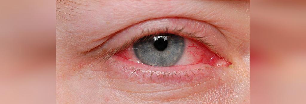 راه های درمان پرش چشم یا تیک چشم
