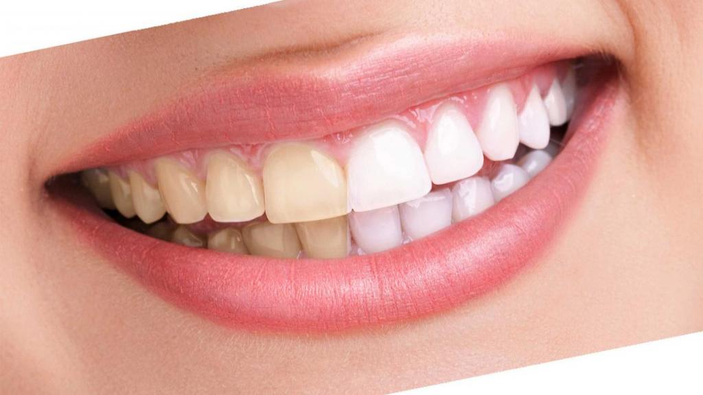 بليچينگ دندان یا سفید کردن دندان چيست + مزایا، معایب و هزینه آن