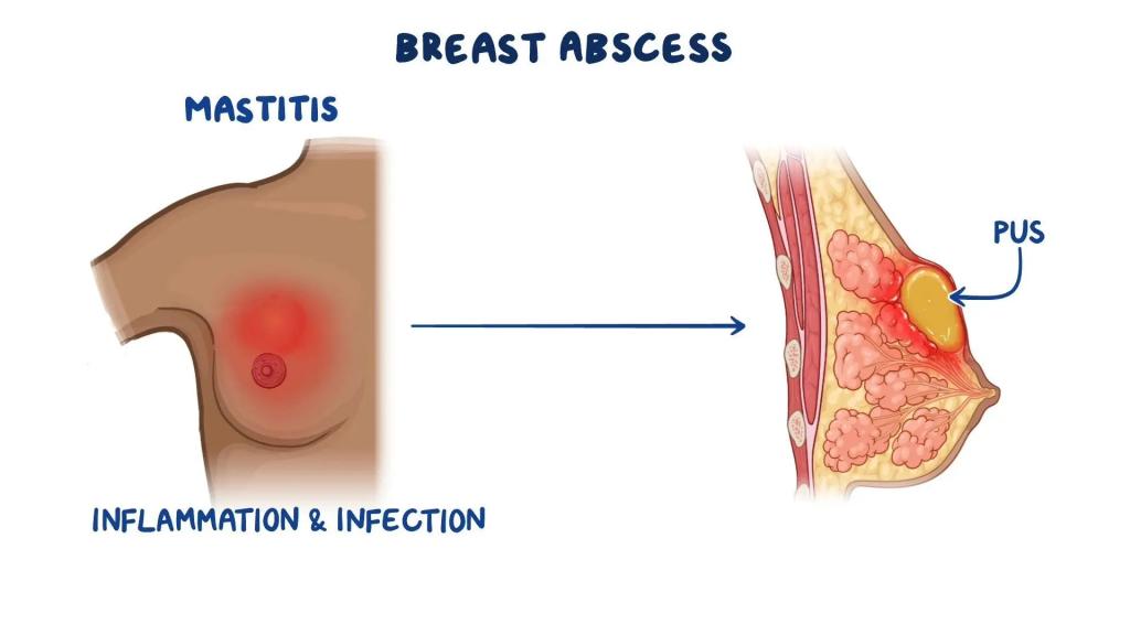 عوامل خطر ابتلا به عفونت پستان