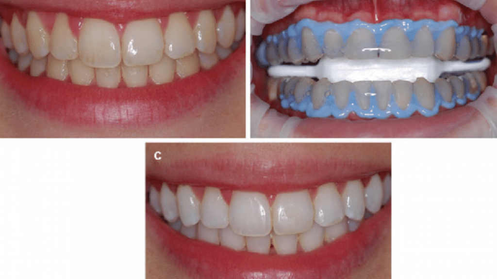 نمونه کار بلیچینگ دندان
