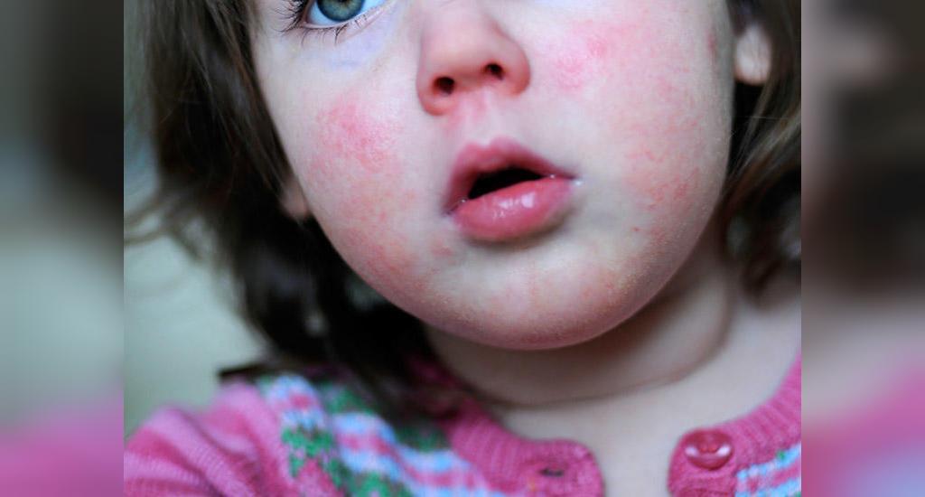 علل و علائم آلرژی پوستی در کودکان