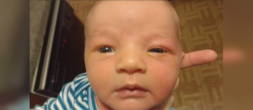 درمان ترشحات زرد رنگ چشم در نوزادان