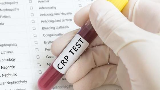 آزمایش پروتئین واکنشی سی یا تست CRP و روش انجام آن چیست؟