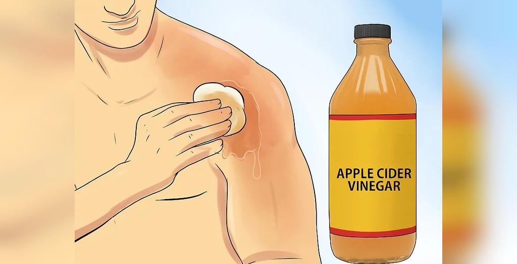 درمان آفتاب سوختگی با سرکه سیب