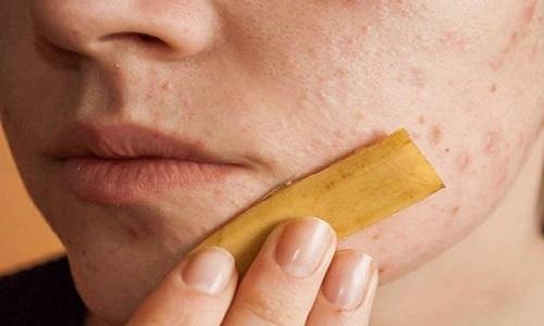  خواص پوست موز برای درمان جوش صورت