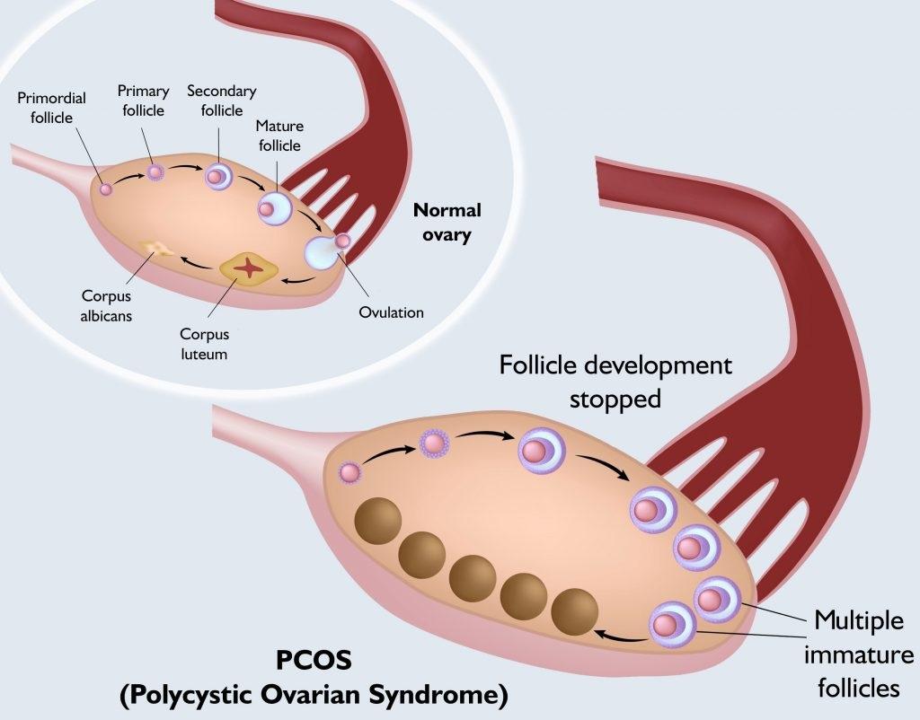 علت بیماری pco چیست