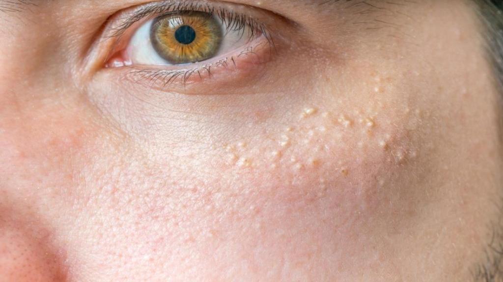 چه عواملی باعث ایجاد لکه های سفید بر روی پوست می شوند و چگونه می توان آنها را درمان نمود؟