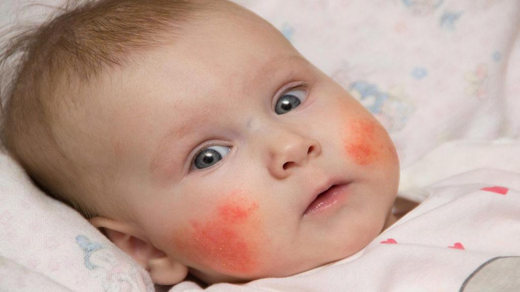 علل جوش صورت نوزاد + بهترین درمان برای جوشهای صورت نوزاد